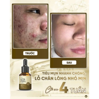 Vita Peel DR.LACIR Tinh Chất Detox Da 50ml Trẻ Hóa Da Sáng Mịn Giá Ưu Đãi 385.000₫