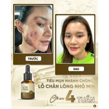 Vita Peel DR.LACIR Tinh Chất Detox Da 50ml Trẻ Hóa Da Sáng Mịn Giá Ưu Đãi 385.000₫
