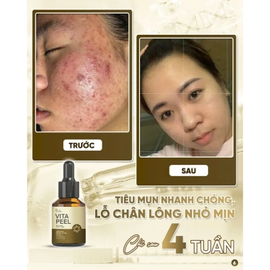 Vita Peel DR.LACIR Tinh Chất Detox Da 50ml Trẻ Hóa Da Sáng Mịn Giá Ưu Đãi 385.000₫ 8 Vita Peel DR.LACIR Tinh Chất Detox Da 50ml Trẻ Hóa Da Sáng Mịn Giá Ưu Đãi 385.000₫ 8