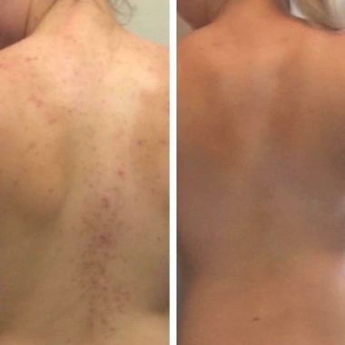 Xịt mụn lưng Skin Fresh AHA và Niacinamide - Giá 60k, se khít lỗ chân lông 6 Xịt mụn lưng Skin Fresh AHA và Niacinamide - Giá 60k, se khít lỗ chân lông 6