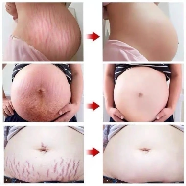 Xoài Xóa Sẹo & Kem Rạn Da 40g Dành Cho Bà Bầu – Giảm 42k, Làm Săn Chắc Sau Sinh 4 Xoài Xóa Sẹo & Kem Rạn Da 40g Dành Cho Bà Bầu – Giảm 42k, Làm Săn Chắc Sau Sinh 4