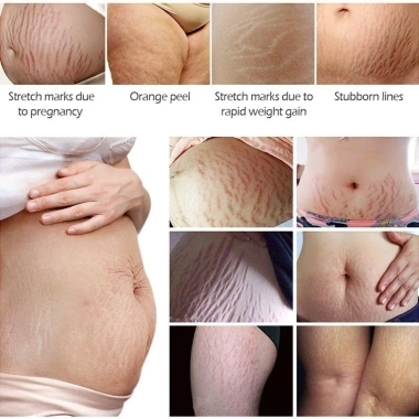 Xoài Xóa Sẹo & Kem Rạn Da 40g Dành Cho Bà Bầu – Giảm 42k, Làm Săn Chắc Sau Sinh