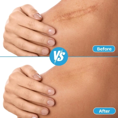 Băng Hydrocolloid cấp y tế cực lớn tự dính, siêu thấm, không thấm nước - Bộ sơ cứu DIY