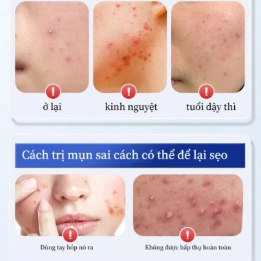 Bộ 36 miếng dán mụn Hydrocolloid TJT - Giảm sưng nhanh, không thấm nước, che mụn hiệu quả, 13.500đ 4 Bộ 36 miếng dán mụn Hydrocolloid TJT - Giảm sưng nhanh, không thấm nước, che mụn hiệu quả, 13.500đ 4
