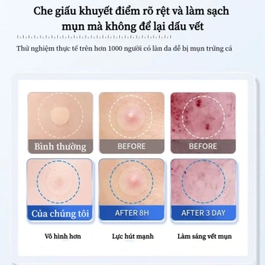 Bộ 36 miếng dán mụn Hydrocolloid TJT - Giảm sưng nhanh, không thấm nước, che mụn hiệu quả, 13.500đ