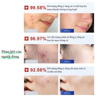 Bộ 36 miếng dán mụn Hydrocolloid TJT - Giảm sưng nhanh, không thấm nước, che mụn hiệu quả, 13.500đ