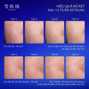 Bộ Dưỡng Trắng Da Sekkisei - Cấp Ẩm, Làm Sáng, Ngăn Da Thô - Giá 999.000₫