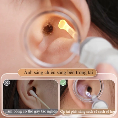 Bộ lấy ráy tai đèn LED thông minh cho bé - Vệ sinh tai an toàn, nhanh, giảm đau 3 Bộ lấy ráy tai đèn LED thông minh cho bé - Vệ sinh tai an toàn, nhanh, giảm đau 3