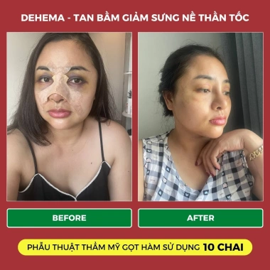 Dehema 100ml - Dung Dịch Uống Bảo Vệ Sức Khỏe, Giảm Sưng Bầm Tím Nhanh Chóng Herbal House 6