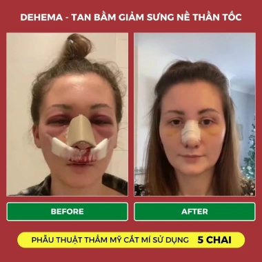 Dehema 100ml - Dung Dịch Uống Bảo Vệ Sức Khỏe, Giảm Sưng Bầm Tím Nhanh Chóng Herbal House 7