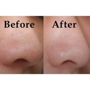 FREE UPSIZE Mặt Nạ Đất Sét Kiềm Dầu Himalaya Neem 100ml Giảm Mụn 165k