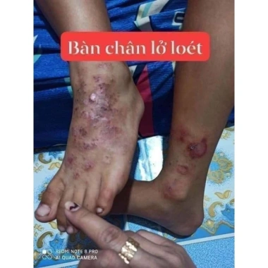 Kem bôi nấm da đầu hắc lào, giảm ngứa, ngừa vẩy nến, hỗ trợ chân tay - chỉ 39.000đ