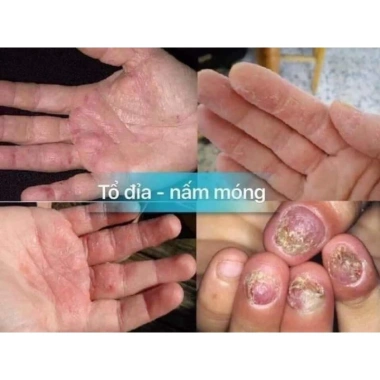 Kem bôi nấm da đầu hắc lào, giảm ngứa, ngừa vẩy nến, hỗ trợ chân tay - chỉ 39.000đ