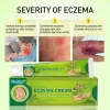 Kem Bôi Ngứa, Eczema, Chàm Da, Mụn Nước, Tổ Đỉa - Thảo Dược An Toàn, Hiệu Quả Tức Thì, Giá 110.880 VNĐ