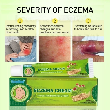 Kem Bôi Ngứa, Eczema, Chàm Da, Mụn Nước, Tổ Đỉa - Thảo Dược An Toàn, Hiệu Quả Tức Thì, Giá 110.880 VNĐ