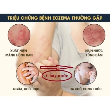 Kem Bôi Ngứa, Eczema, Chàm Da, Mụn Nước, Tổ Đỉa - Thảo Dược An Toàn, Hiệu Quả Tức Thì, Giá 110.880 VNĐ