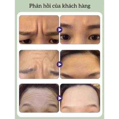 Miếng Dán Chống Lão Hóa Ban Đêm Giảm Nếp Nhăn - Dưỡng ẩm Trán & Mắt, Kem Trẻ Hóa Da 70.000₫ 3 Miếng Dán Chống Lão Hóa Ban Đêm Giảm Nếp Nhăn - Dưỡng ẩm Trán & Mắt, Kem Trẻ Hóa Da 70.000₫ 3