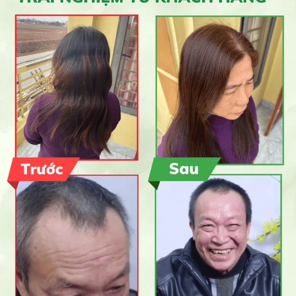 Dù có những ưu điểm, nhưng tình trạng da đầu khô và ngứa sau một vài ngày là vấn đề phổ biến. (Ảnh 3) Dù có những ưu điểm, nhưng tình trạng da đầu khô và ngứa sau một vài ngày là vấn đề phổ biến. (Ảnh 3)