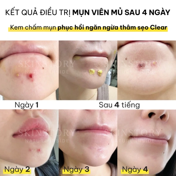 Trong thị trường hiện nay, có rất nhiều loại kem trị mụn được quảng cáo “có nghệ”. (Ảnh 4)