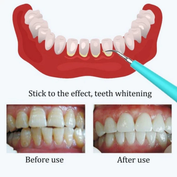 Chi tiết nhỏ khiến việc dùng dụng cụ lấy cao răng tại nhà trở nên rủi ro hơn bạn nghĩ - Ảnh 5