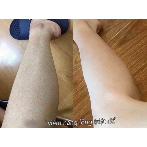 Bôi lotion giảm ngứa hậu môn vào buổi tối giúp duy trì độ ẩm lâu hơn – Điều mà nhiều người chưa biết - Ảnh 4