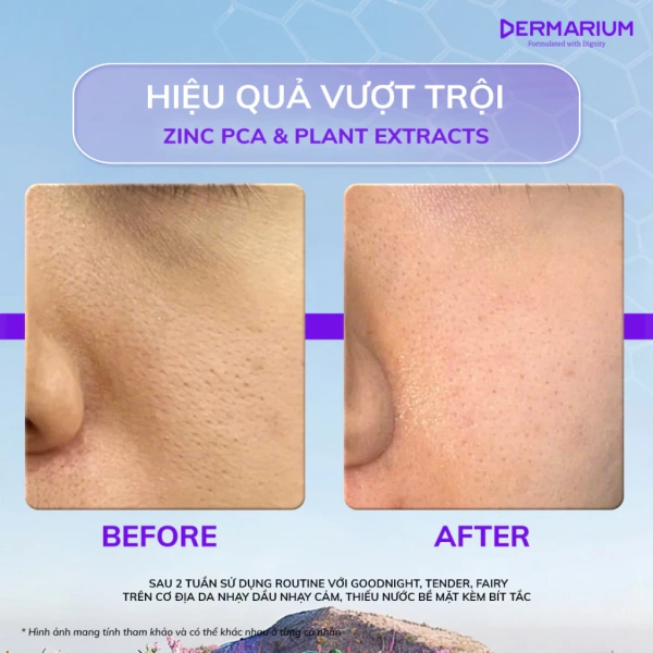 Zinc PCA (Pyrrolidone Carboxylic Acid) là dạng muối của kẽm liên kết với axit pyrrolidone, được biết đến với khả năng điều tiết bã nhờn và có tính kháng khuẩn nhẹ. (Ảnh 4) Zinc PCA (Pyrrolidone Carboxylic Acid) là dạng muối của kẽm liên kết với axit pyrrolidone, được biết đến với khả năng điều tiết bã nhờn và có tính kháng khuẩn nhẹ. (Ảnh 4)