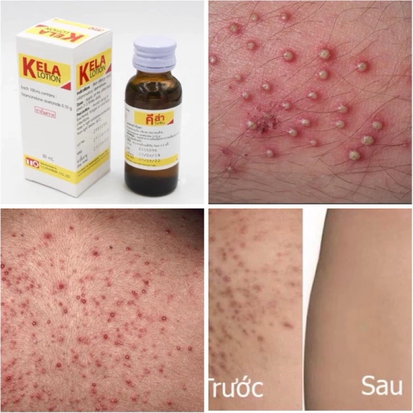Bôi lotion giảm ngứa hậu môn vào buổi tối giúp duy trì độ ẩm lâu hơn – Điều mà nhiều người chưa biết