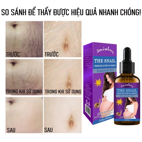 Khi tinh chất ốc sên trở thành giải pháp, nhiều bà mẹ nhận ra vết rạn da sau sinh ảnh hưởng sâu đến sự tự tin của mình