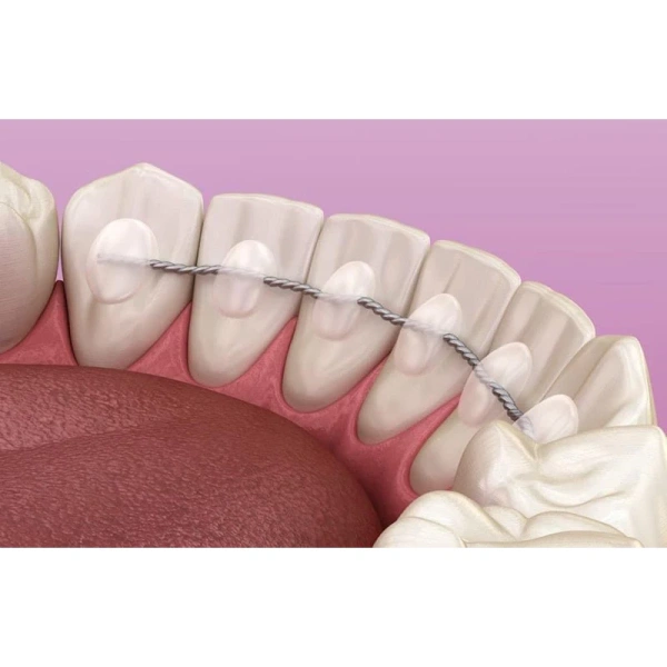 Dây duy trì xoắn dài 150 mm thực sự gây phiền hà trong vệ sinh răng miệng hơn mong đợi - Ảnh 1