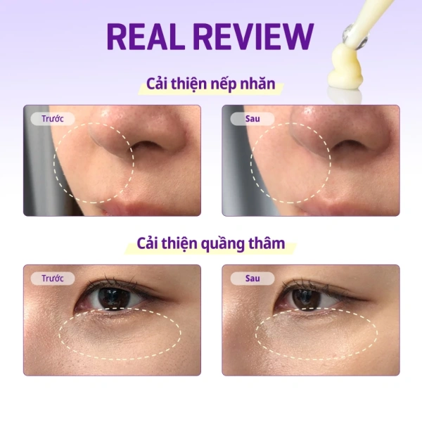 Trong trường hợp da bị đỏ nặng, có dấu hiệu viêm, hoặc xuất hiện mụn viêm ở vùng mắt, nên dừng dùng ngay lập tức và chuyển sang các sản phẩm làm dịu như kem chứa alantoine hoặc tinh chất nha đam. (Ảnh 5)