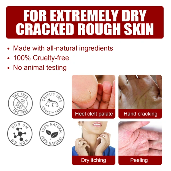 Vết chai trên da chân thường là những lớp da chết dày đặc, giàu keratin. (Ảnh 2)