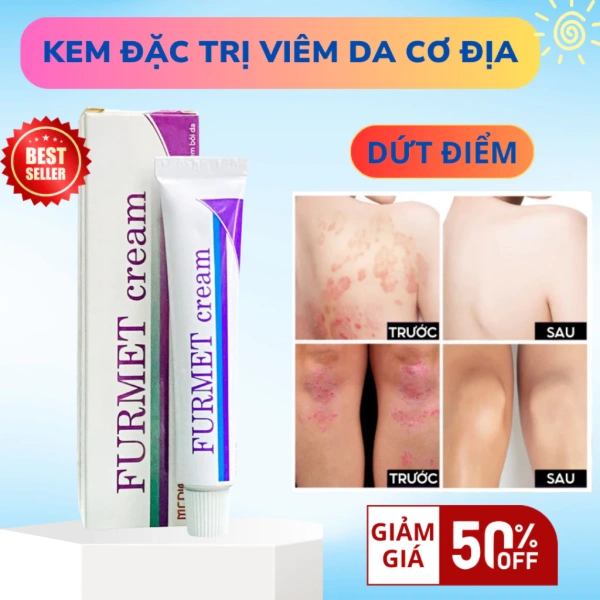 Những dấu hiệu cho thấy kem trị ngứa da cơ địa đã đạt giới hạn hiệu quả trong quá trình dùng kéo dài
